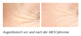 Meso Anti Aging - Skinline Cosmetics - Kosmetikstudio Offenbach am Main